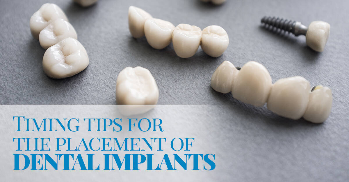 timing tips for the placement of dental implants